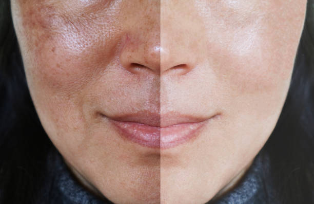 Read more about the article Open Pores treatment: we  will discuss about Open Pores,here are 4 major problem we will solve