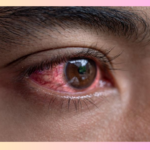 Eye Flu:  Symptoms ,Reasons and Treatments