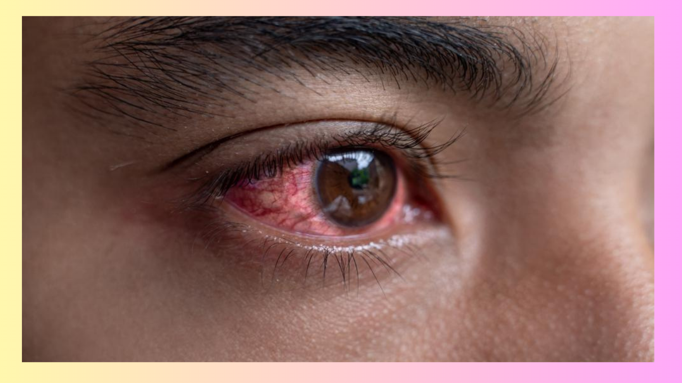 Read more about the article Eye Flu:  Symptoms ,Reasons and Treatments